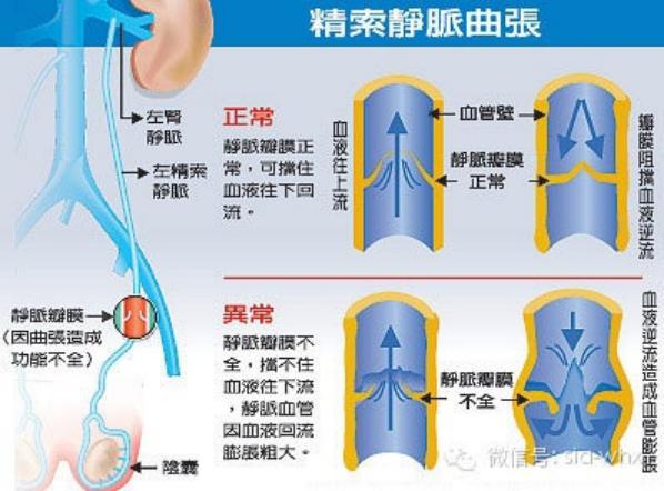 關于2021年征兵精索靜脈曲張標準的探討，2021年征兵精索靜脈曲張標準深度解析